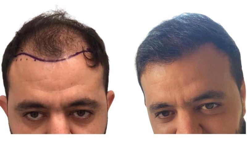 antes y despues de injertos de pelo