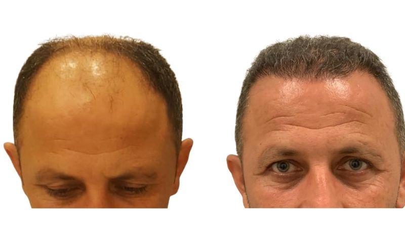 bono antes y despues del trasplante de pelo