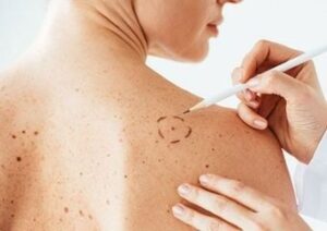 Lee más sobre el artículo ¡Cuidado con el cáncer de piel!