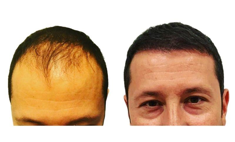 implante de cabello antes y despues