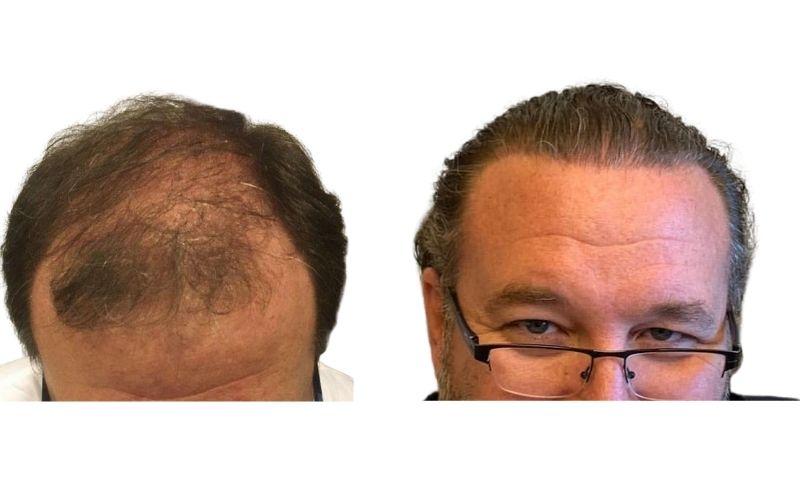 implante pelo antes y despues