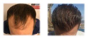 fue saç ekimi öncesi ve sonrası