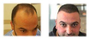 fue saç ekimi öncesi ve sonrası