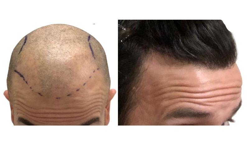 trasplante de cabello antes y despues